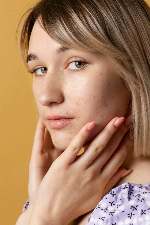 A woman affected by acne poses thoughtfully against a bright yellow backdrop, focusing on skincare