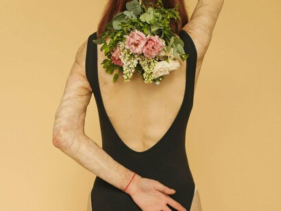 A woman whose skin tells a story of survival, posing with a bouquet of fresh flowers, symbolizing rebirth and resilience