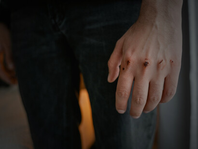 A man prone to violence, his hands covered in wounds