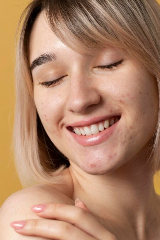 A woman with acne stands in front of a yellow background, emphasizing skincare care
