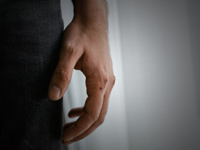 A man with a history of violence, his hands visibly injured