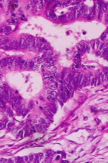 Adenocarcinoma de recto