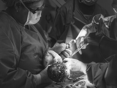 Black-and-white photo of a doctor holding a baby during a C-section operation in a hospital