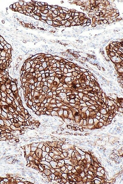 PD-L1 en adenocarcinoma de pulmón