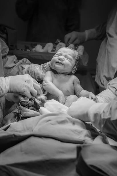 The birth of a baby by cesarean section, a medical procedure that highlights the importance of respectful communication during childbirth