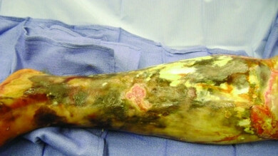 Fascitis necrotizante causada por Vibrio Vulnificus