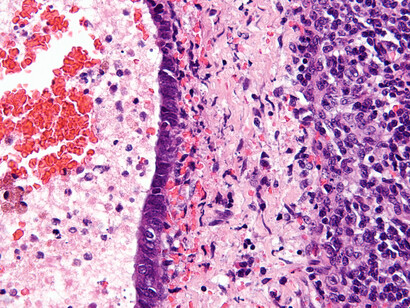 La endometriosis es una afección seria y el diagnóstico temprano es clave para abordarla de manera efectiva. Ganglio linfático con endometriosis