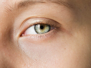 La dacriocistorrinostomía mediante láser (DCR), es una técnica por la que se crea un nuevo canal para el drenaje lagrimal mediante láser, de forma menos invasiva que la cirugía convencional, a partir de un abordaje externo