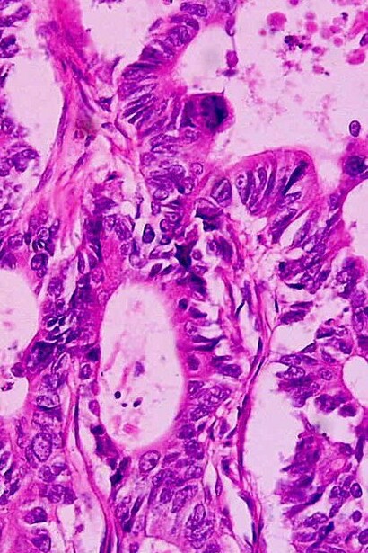Adenocarcinoma de recto