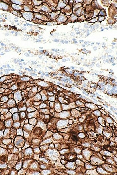 PD-L1 en adenocarcinoma de pulmón