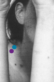 A person suffering from mental illness