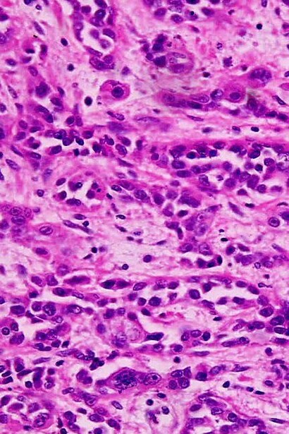 Adenocarcinoma de estómago