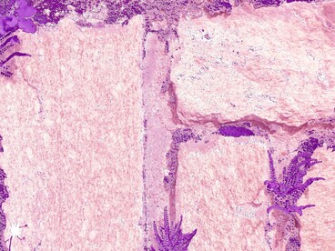 La fibromialgia è una sindrome cronica caratterizzata da dolore muscoloscheletrico diffuso, affaticamento e disturbi del sonno, la cui eziologia rimane multifattoriale e non completamente definita