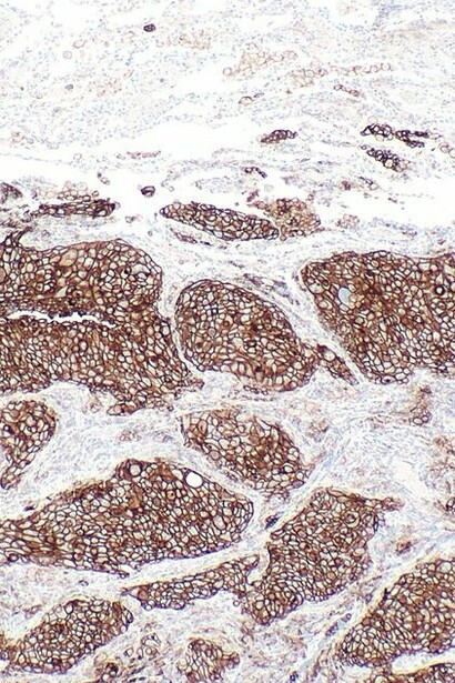 PD-L1 en adenocarcinoma de pulmón