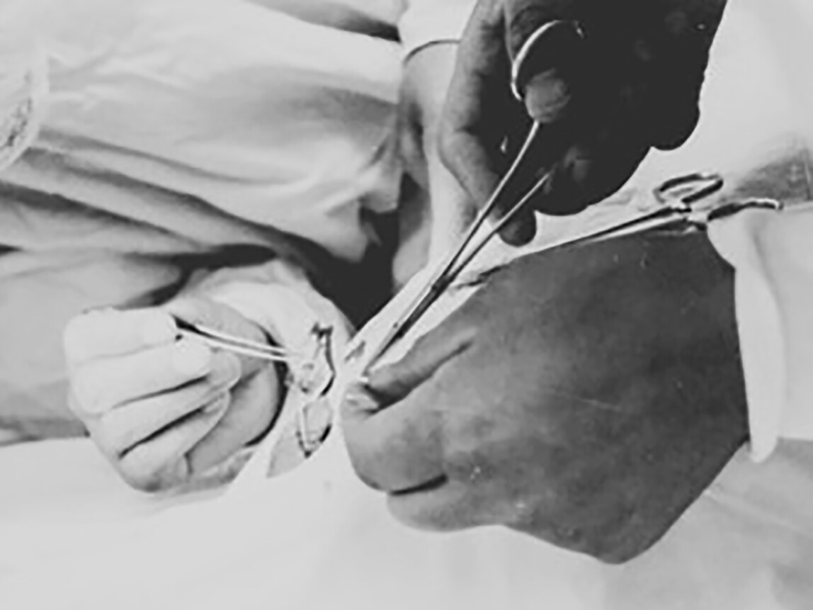 Acupuncture anesthesia and pingpong diplomacy Meer