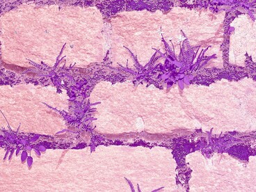 Le ricerche suggeriscono un’alterazione nei meccanismi di percezione e modulazione del dolore a livello del sistema nervoso centrale